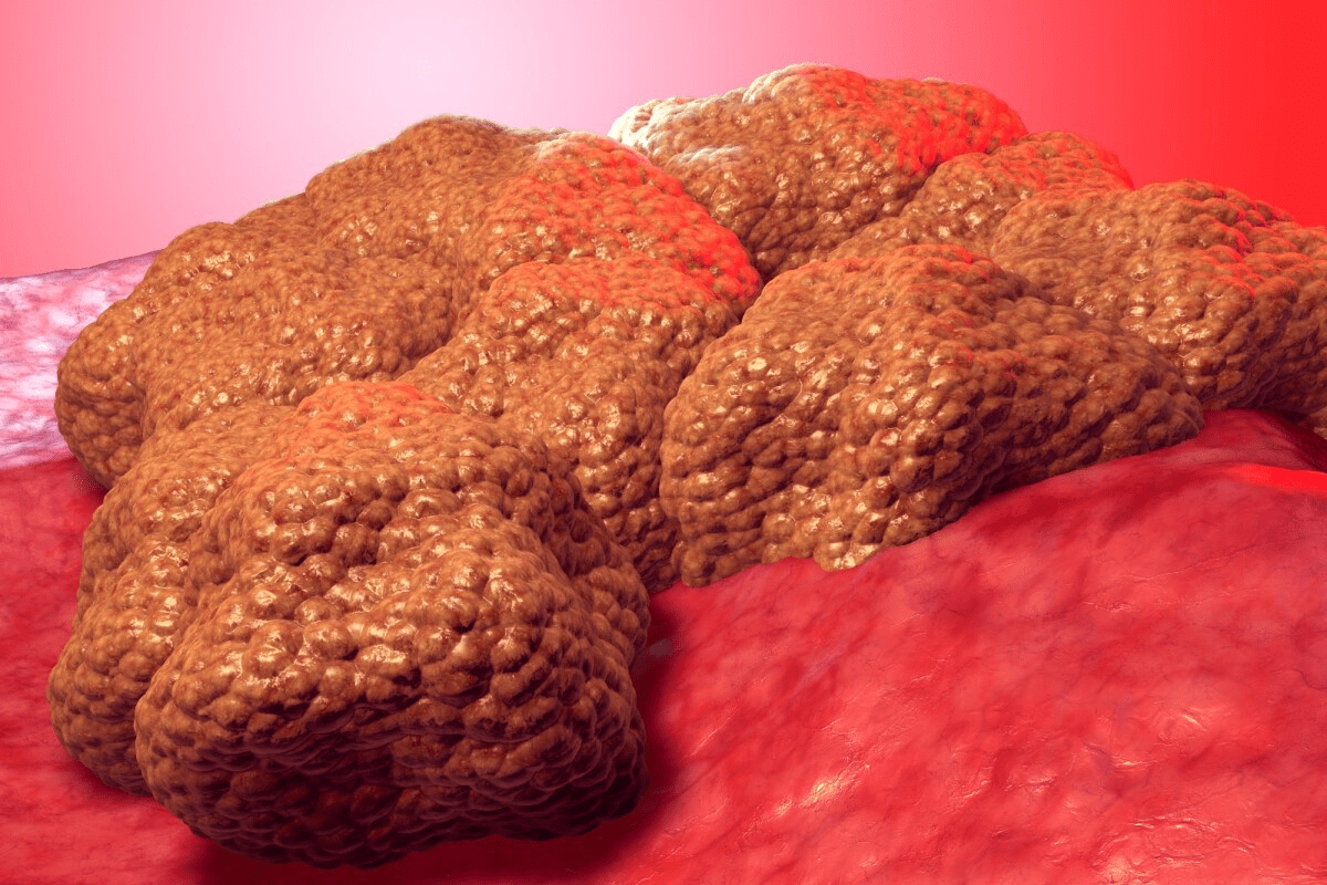 Tumors Melting: The new cancer treatment breakthrough.