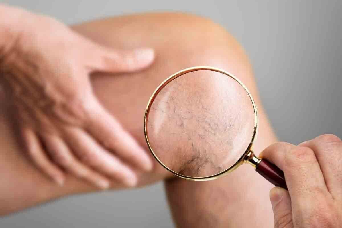 c"What Does a Blood Clot in the Leg Feel Like and Can You Detect Its Movement? What Does a Blood Clot Feel Like"