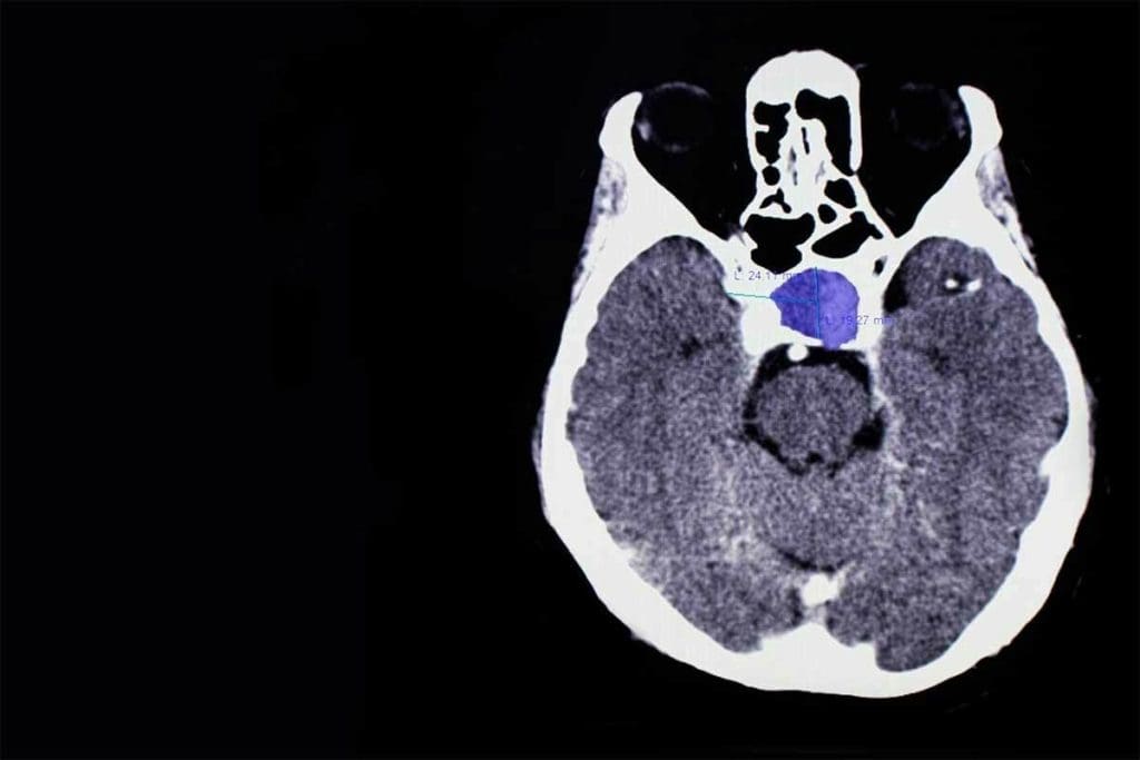 CT Thyroid Gland: 7 Essential Insights Revealed Now