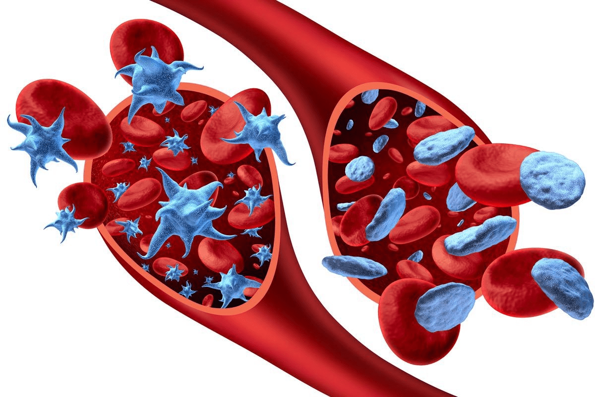 ITP in Children: Amazing Recovery Facts