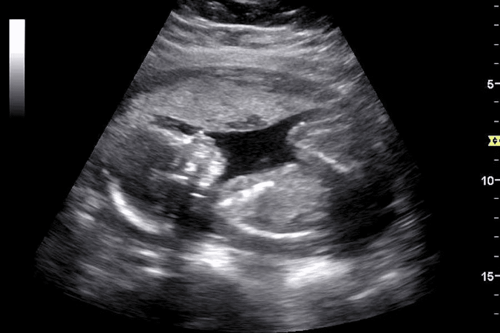 Black Mass on Ultrasound Picture: What Does It Mean? 3 Black Mass on Ultrasound Picture: What Does It Mean?