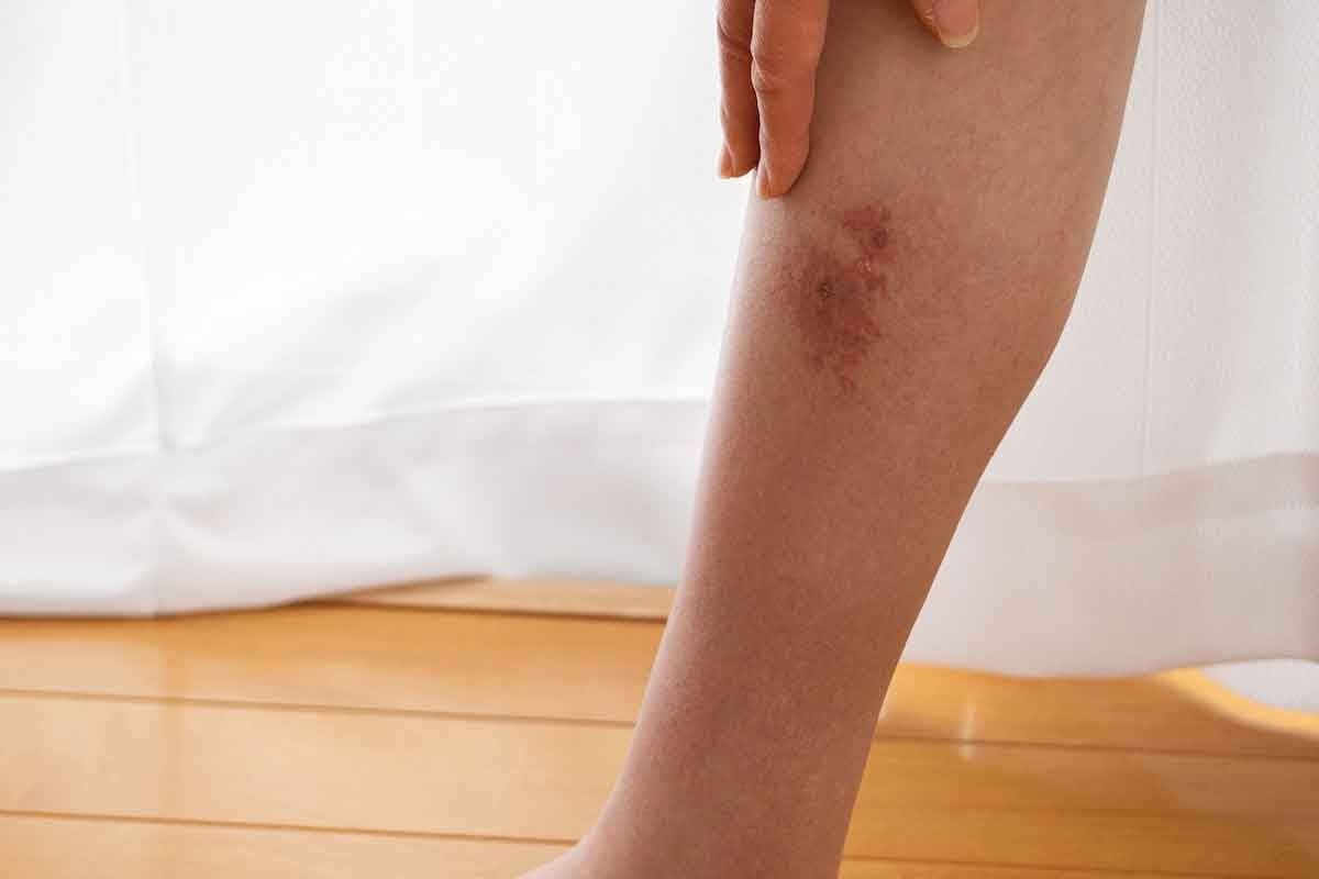 Do Blood Clots Cause Bruising? How to Tell the Difference Between a Bruise and a Blood Clot