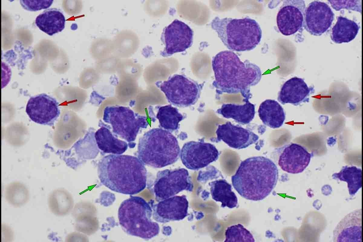 Blood Test Lymph: What Does a Low Lymphocyte Count Mean?