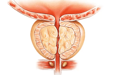 Causes of Prostate Enlargement: Key Drivers
