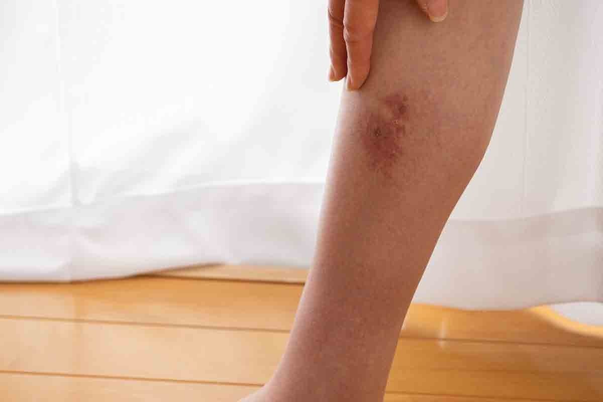 Do Blood Clots Resolve on Their Own? What Happens If You Leave a Blood Clot Untreated?