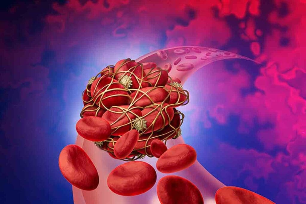 Does DVT Go Away on Its Own? Understanding Blood Clot Resolution