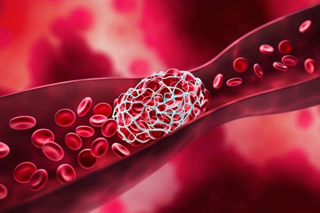 Blood Thinners and Bruising Pictures: What to Expect