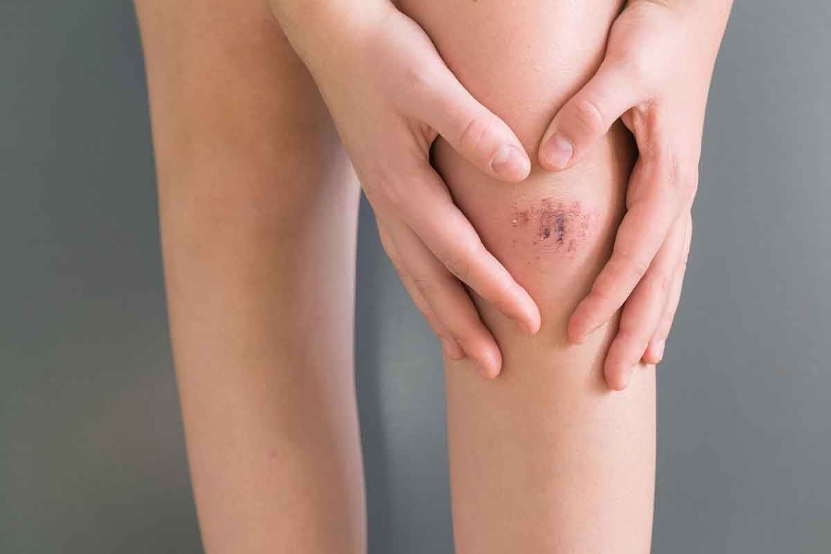 Blood Clot in Leg Bruise: How to Tell the Difference