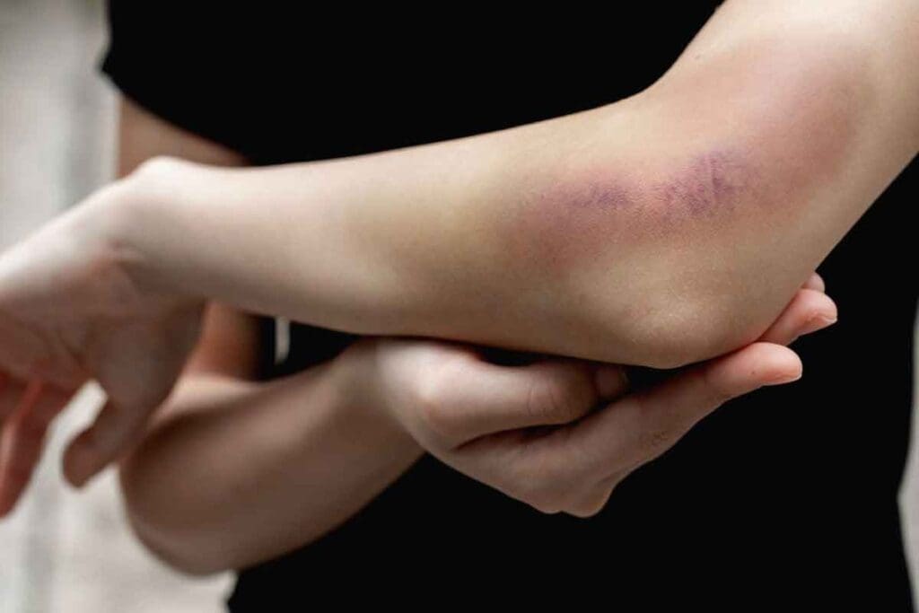 How Can You Tell If It's a DVT or Just a Bruise? Key Differences and Signs