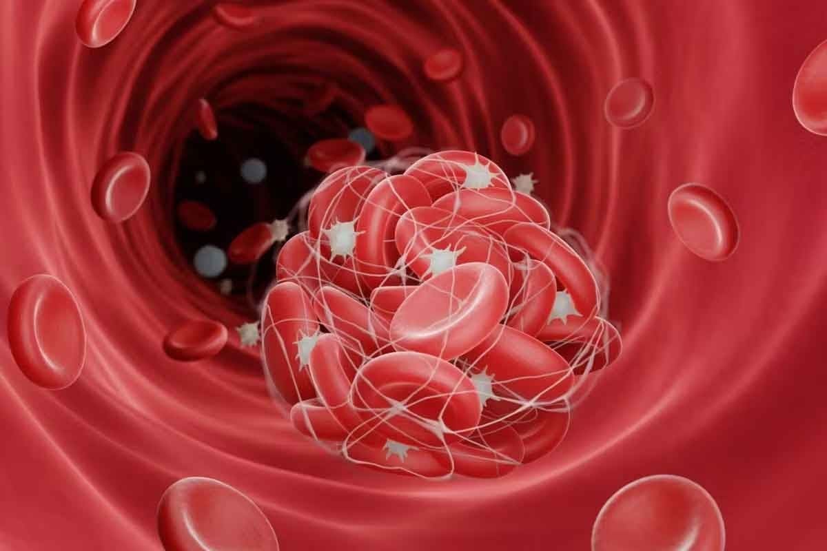 How Serious Is an Abdominal Blood Clot and What Should You Do?