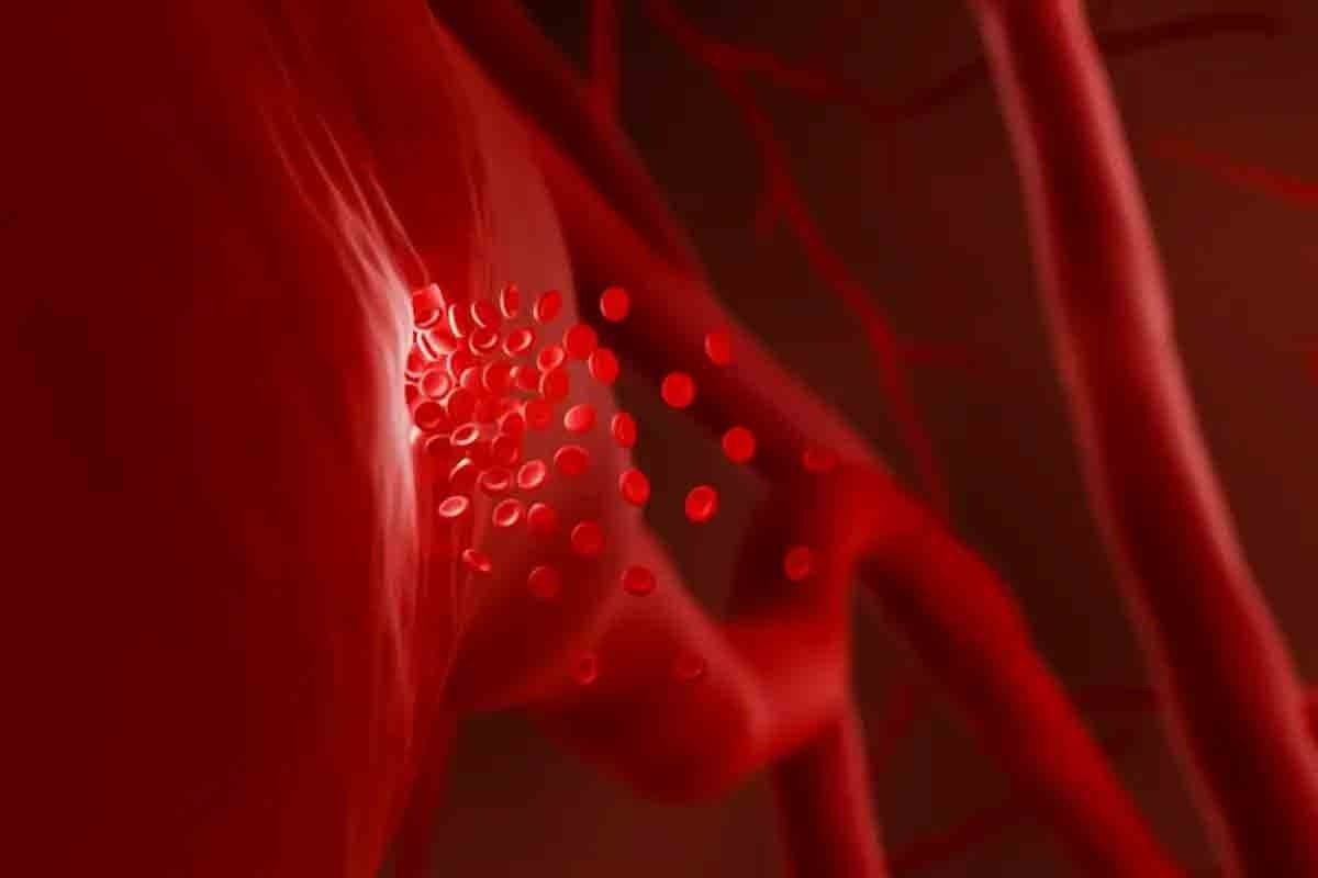 How Long Does It Take for Blood Clots to Dissolve and Can They Go Away on Their Own?