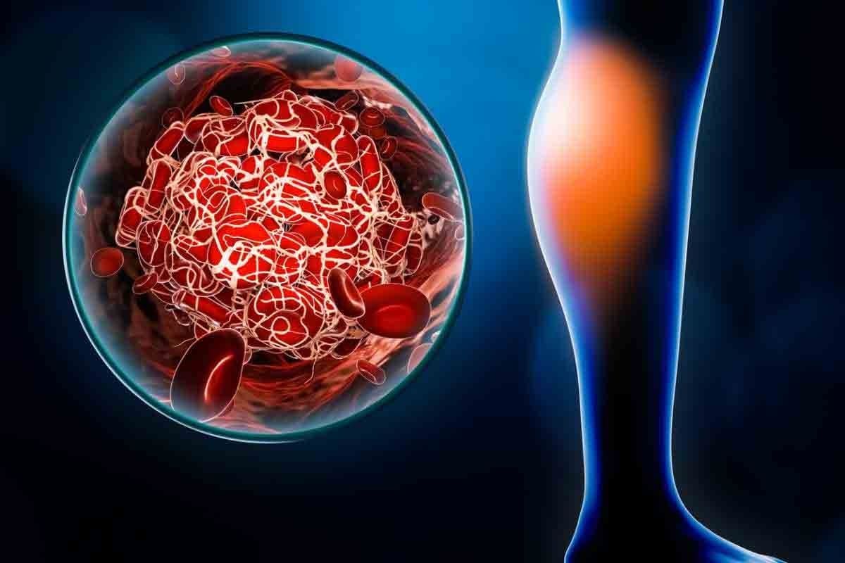 How Long Does It Take for Do Blood Clots Dissolve On Their Own ?