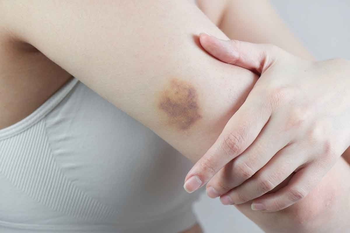 Do Blood Clots Look Like Bruises? How Can You Tell the Difference Between a Blood Clot and a Bruise?