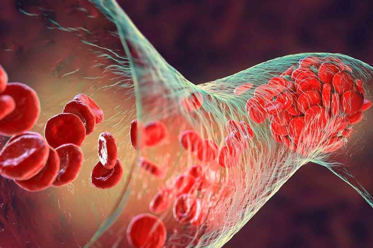 How Long Does It Take for a Blood Clot (DVT) to Heal and Go Away?