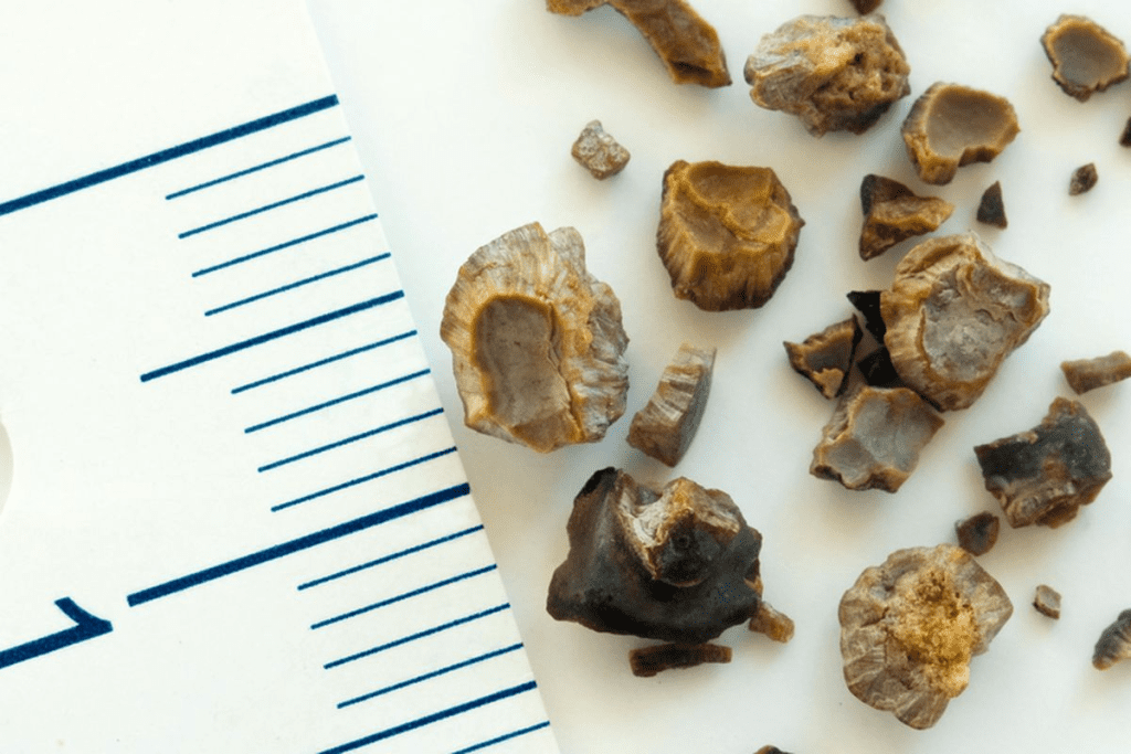 How to Prevent Kidney Stones: Top 7 Proven Vitamins You Need 3 How to Prevent Kidney Stones: Top 7 Proven Vitamins You Need