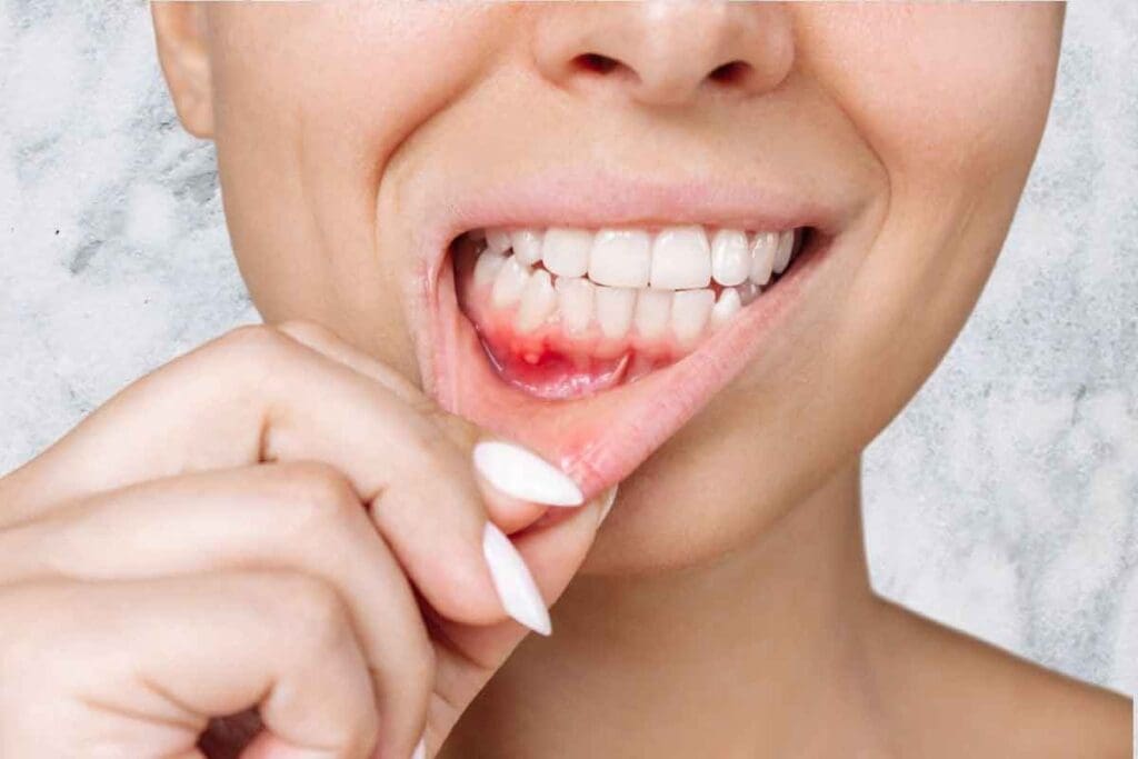 Early Stage Leukemia Bleeding Gums: 7 Crucial Facts 1 Early Stage Leukemia Bleeding Gums: 7 Crucial Facts