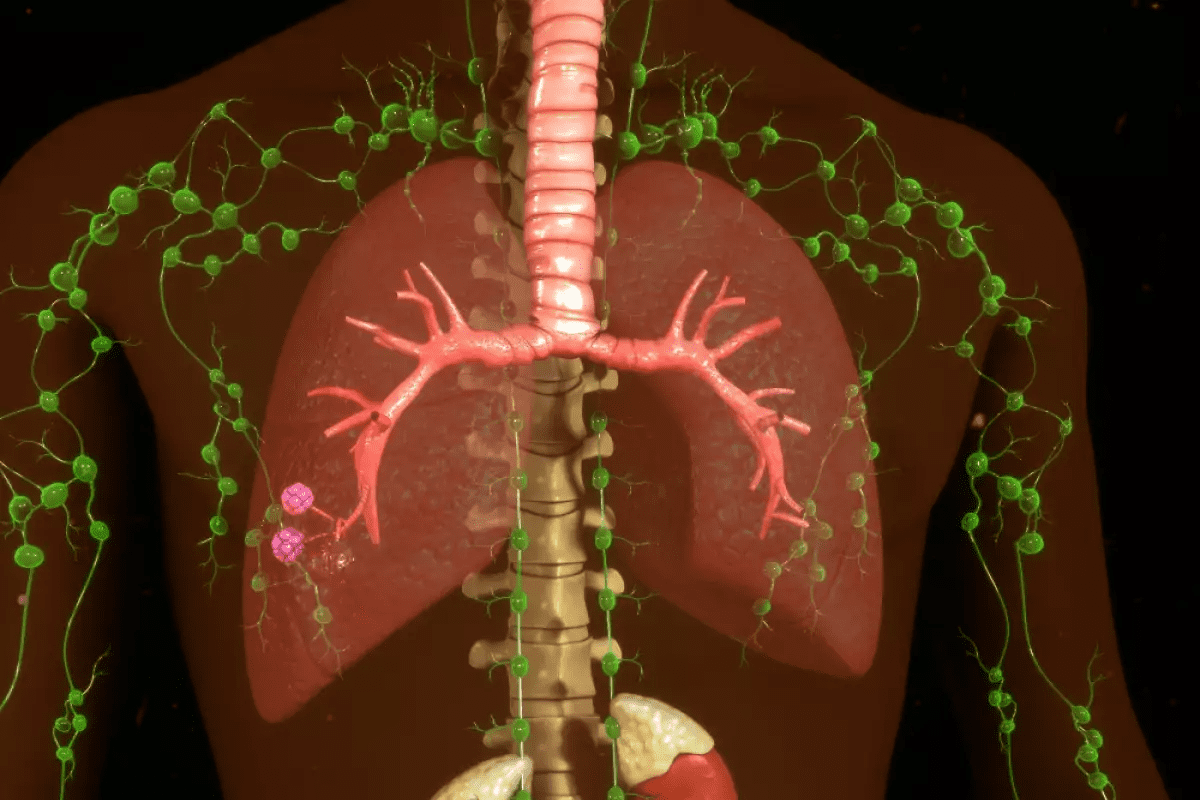 Clear Lymph Nodes & Chemo, not can you live without bladder