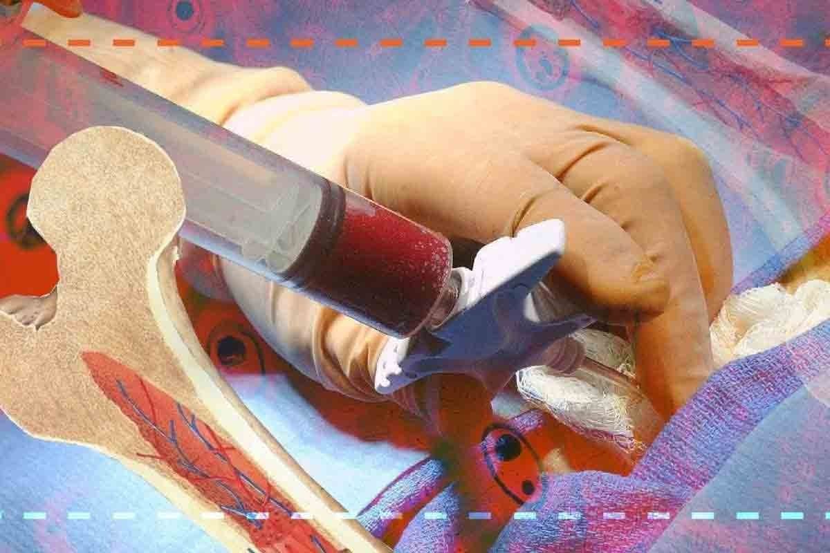 Pathology Of Aplastic Anemia: 7 Key Facts & Findings