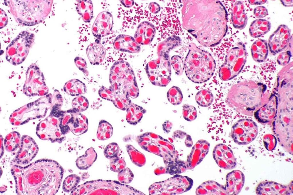 7 Key Facts About Marrow Hypoplasia: Causes, Symptoms, and Treatment 3 7 Key Facts About Marrow Hypoplasia: Causes, Symptoms, and Treatment