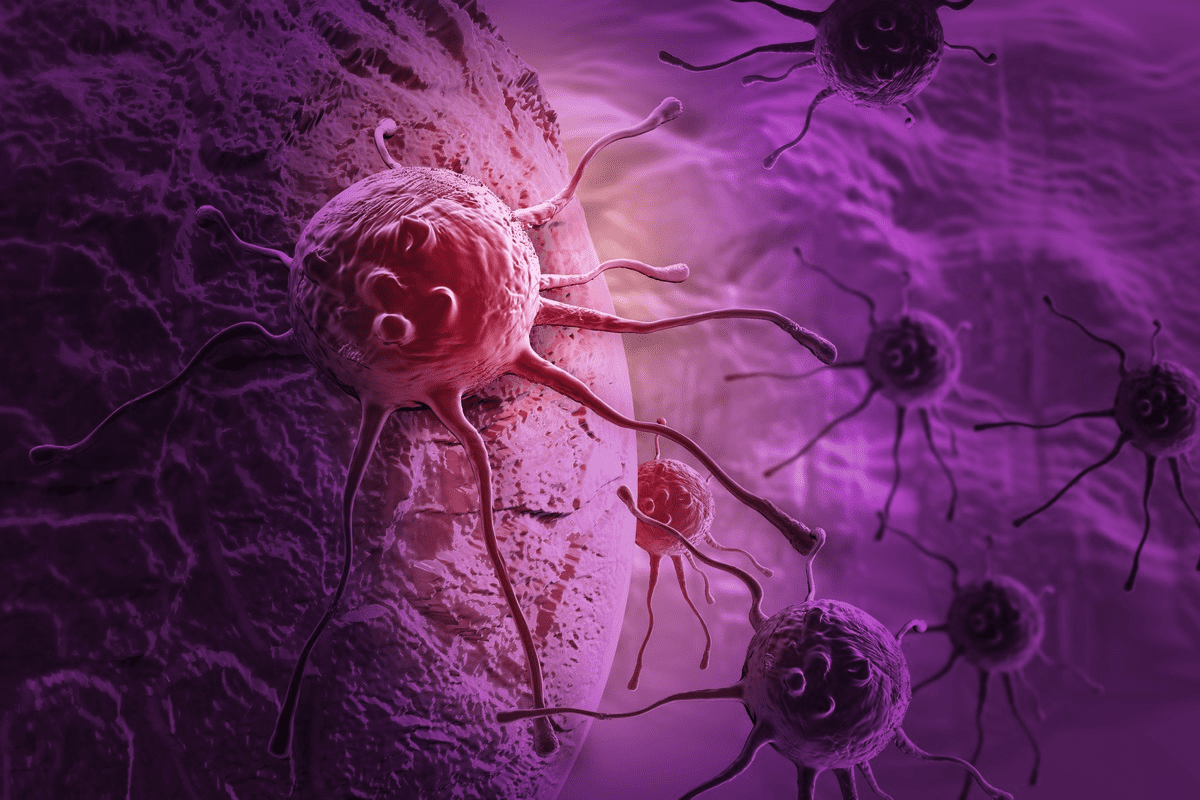 Radiotherapy for Cancer: Shrink Tumors Fast