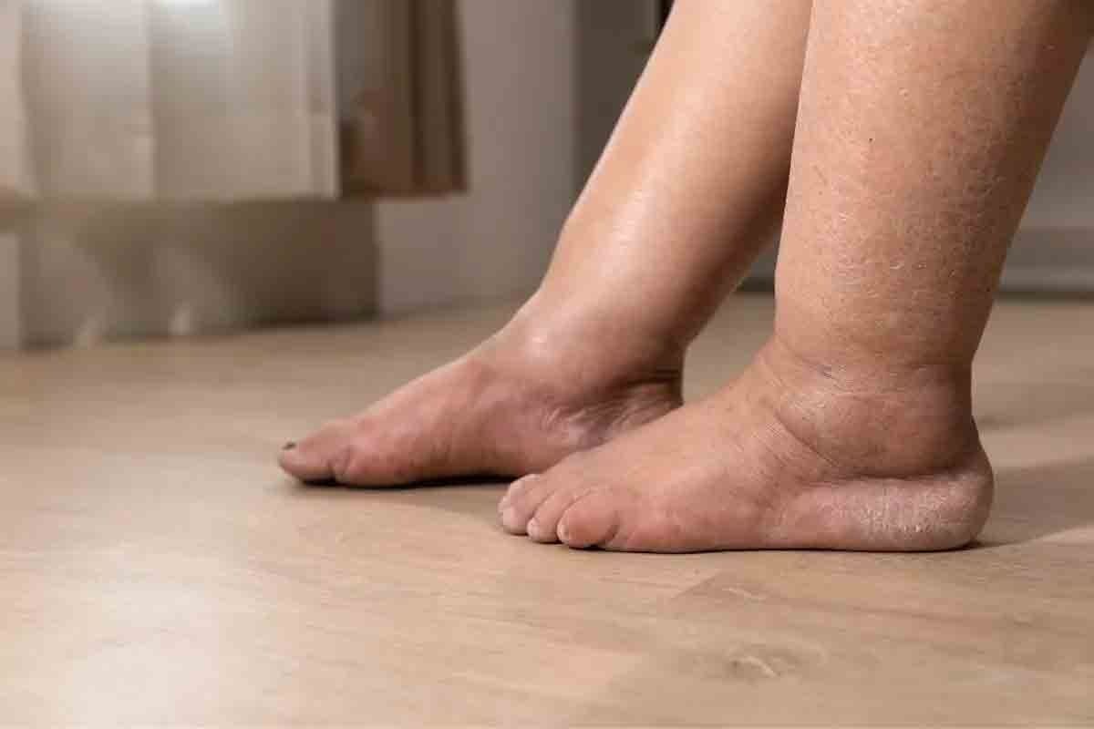 Swollen Feet Anemia: Crucial Causes of Edema Explained