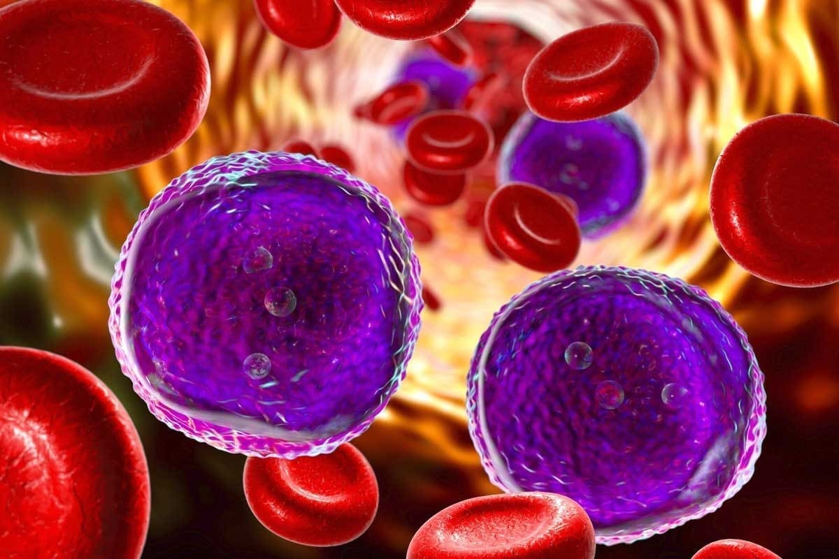 Pre B Cell Acute Lymphoblastic Leukemia: 7 Key Facts
