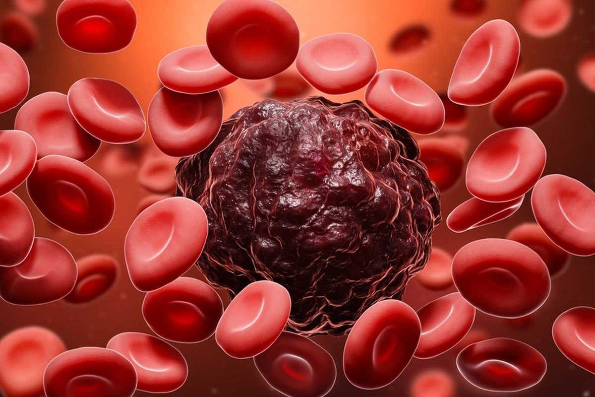 Precursor B Cell Acute Lymphoblastic Leukemia: 7 Key Facts