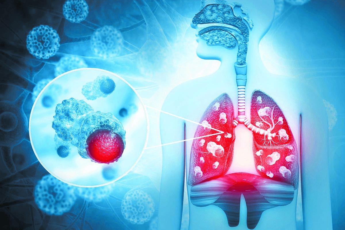 Blood Cancers: Most Common Hematologic Cancer