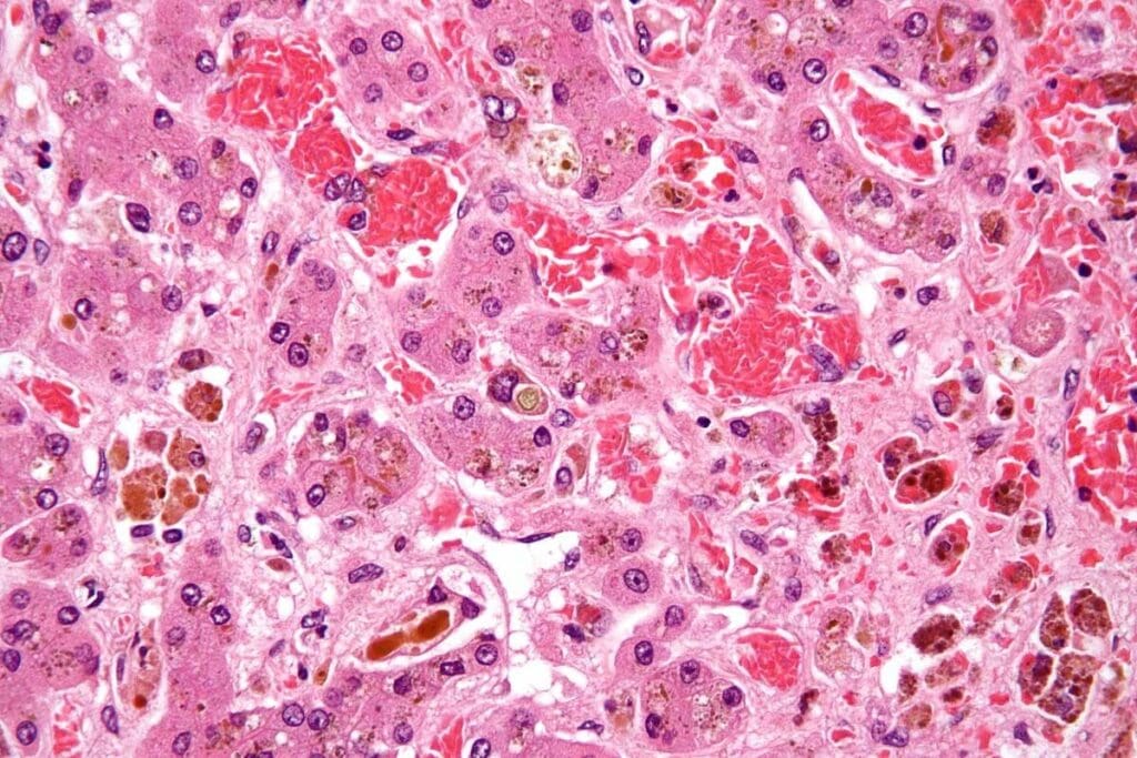 Can White People Have Sickle Cell Anemia? Explained 2 Can White People Have Sickle Cell Anemia? Explained