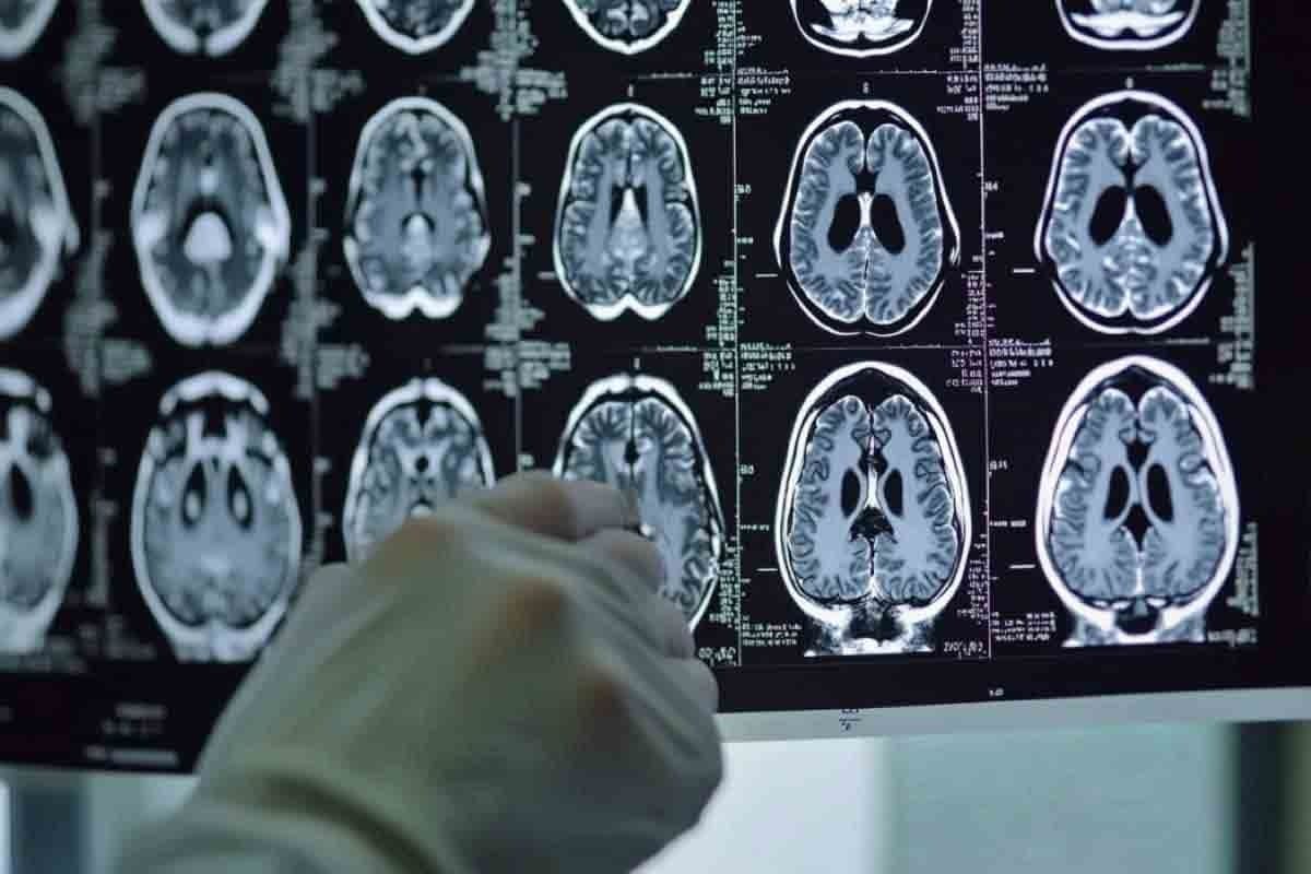 Cerebellar Tumor Symptoms: 15 Key Brain Tumor Warning Signs