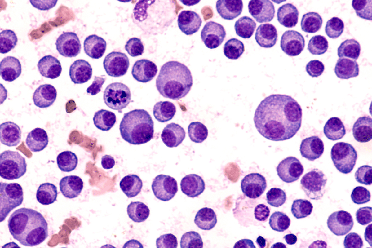 Leukemia Treatment That Gives Hope: Latest Strategies Revealed