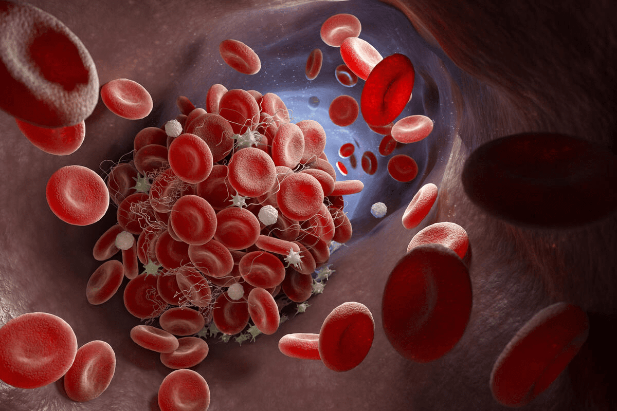 What Causes Blood Clots: Essential Lifestyle Negative Factors