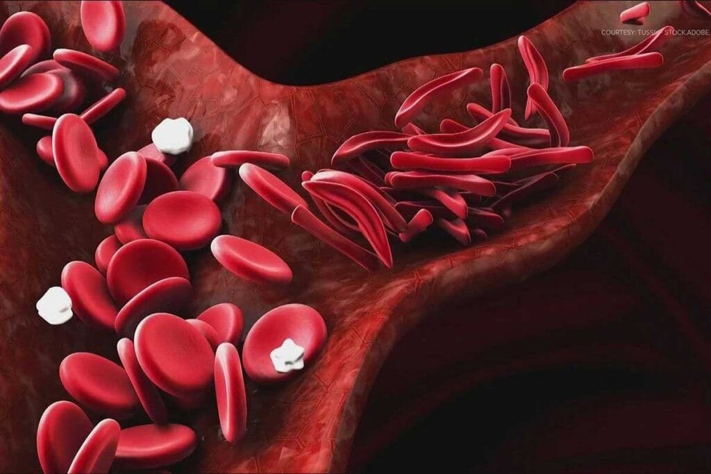 Sickle Cell Anemia Black People: How Common It Is