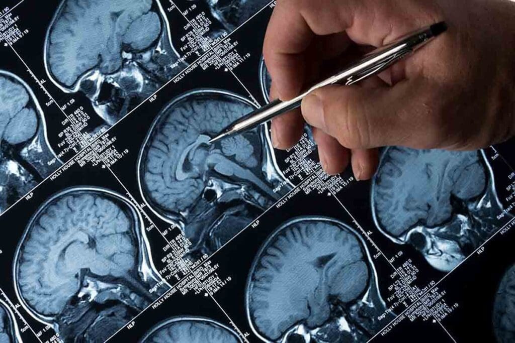 Causes of Brain Tumors in Teenagers: 7 Early Warning Signs 2 Causes of Brain Tumors in Teenagers: 7 Early Warning Signs