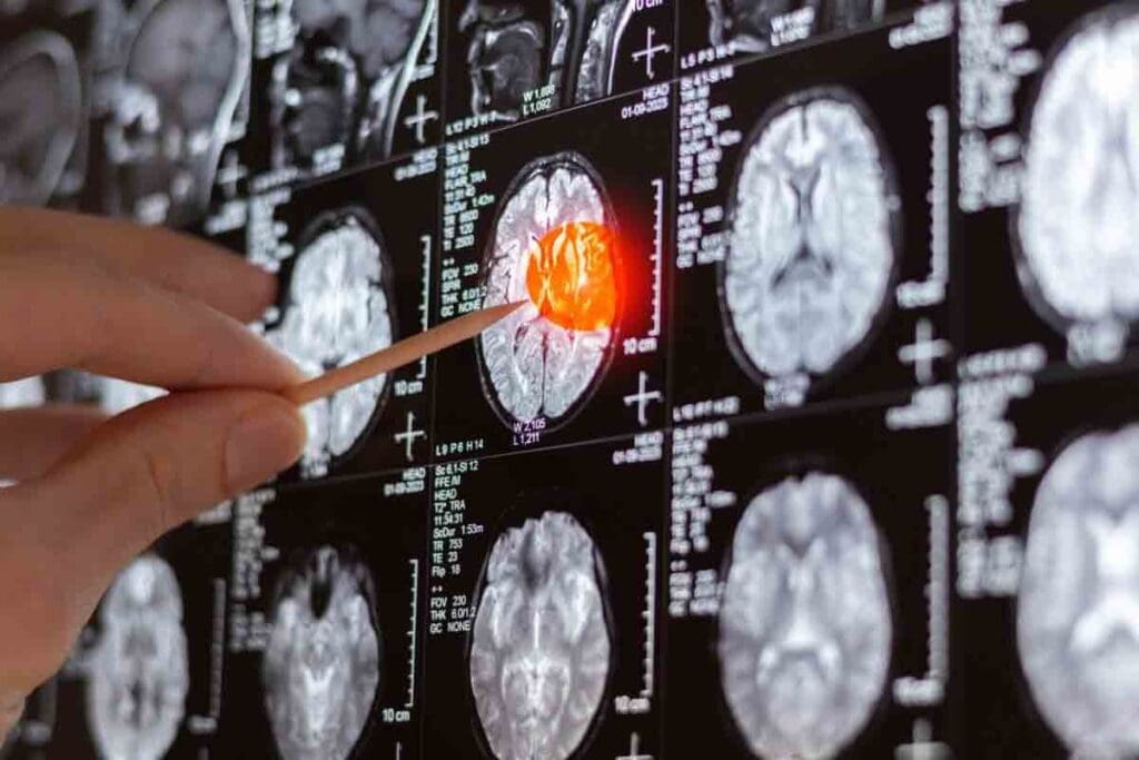 Causes of Brain Tumors in Teenagers: 7 Early Warning Signs 3 Causes of Brain Tumors in Teenagers: 7 Early Warning Signs