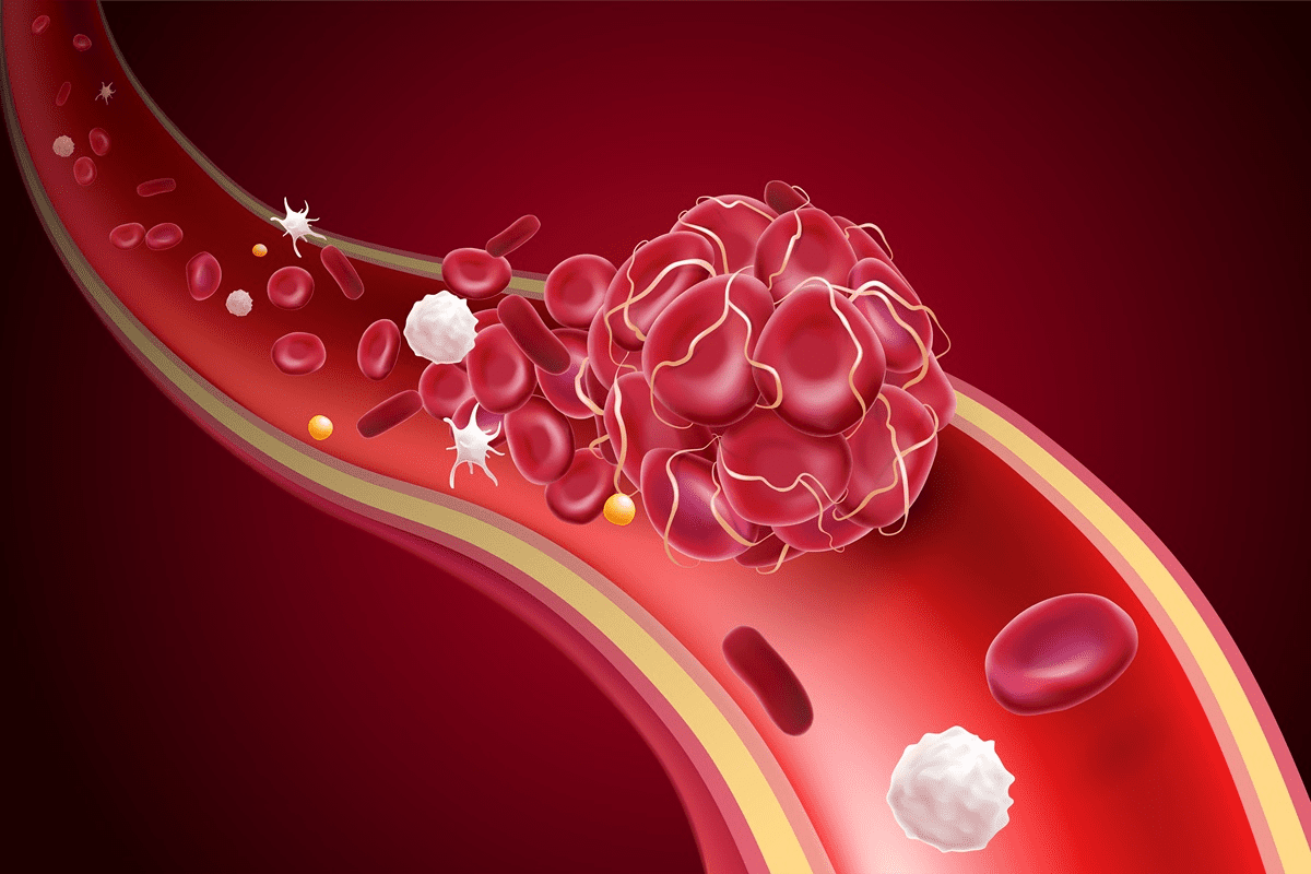 How to Check for a Blood Clot in Your Leg: A Critical Guide
