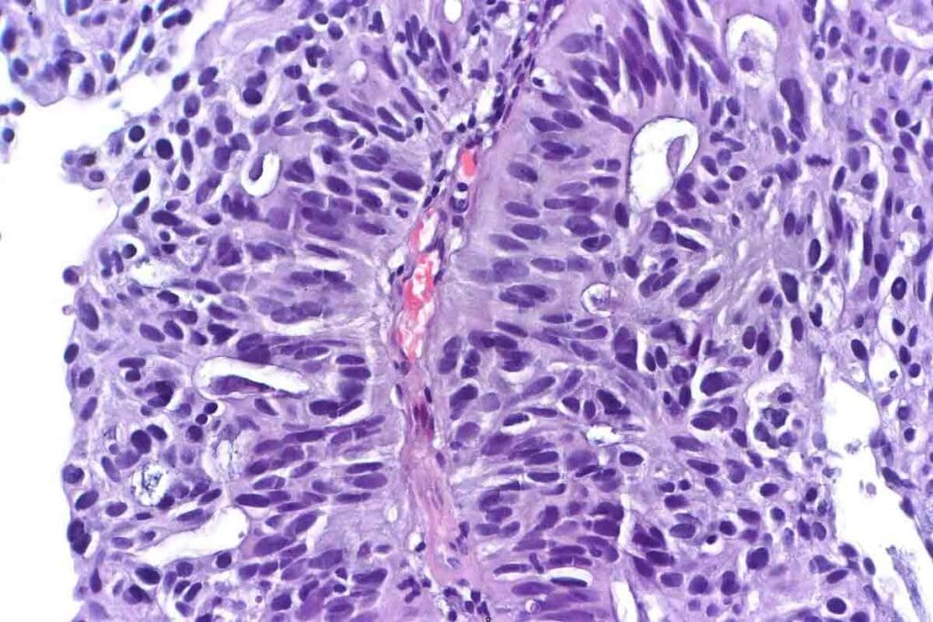 Arms Cancer: Symptoms and Treatment for Alveolar Rhabdomyosarcoma 1 Arms Cancer: Symptoms and Treatment for Alveolar Rhabdomyosarcoma
