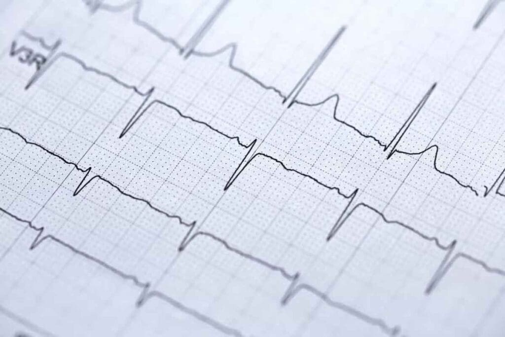 Catheter Ablation: How It Treats Heart Issues