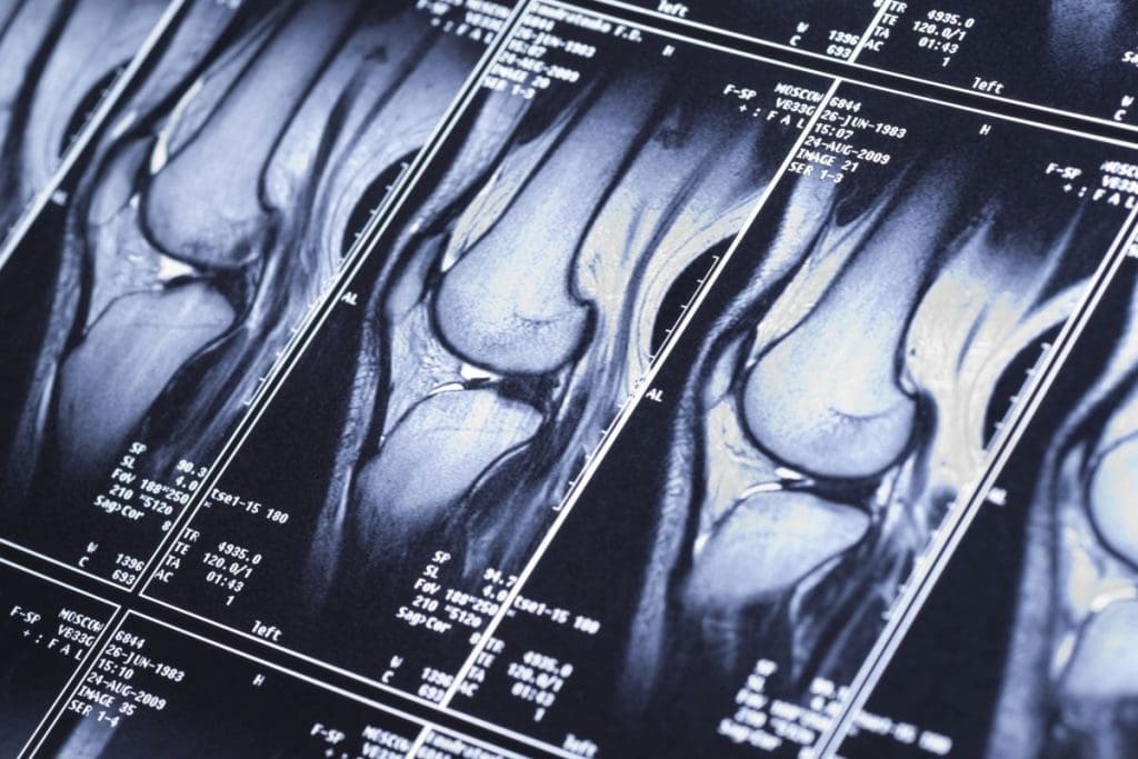Nuc Med Bone Scan: What It Shows