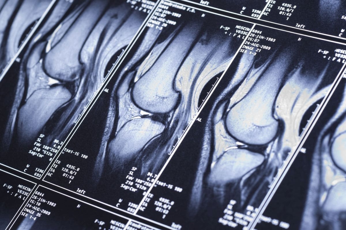 Nuc Med Bone Scan: What It Shows