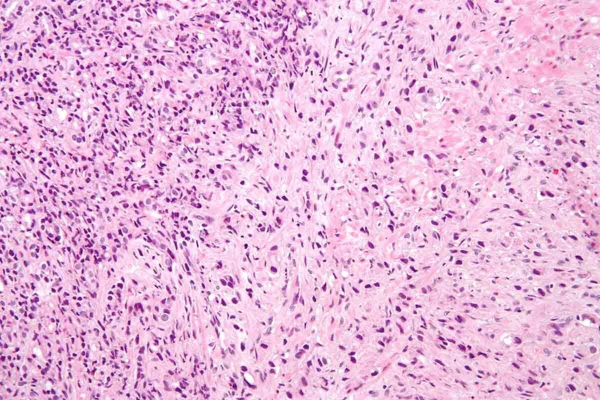 soft tissue sarcoma in leg — Early Signs and Appearance