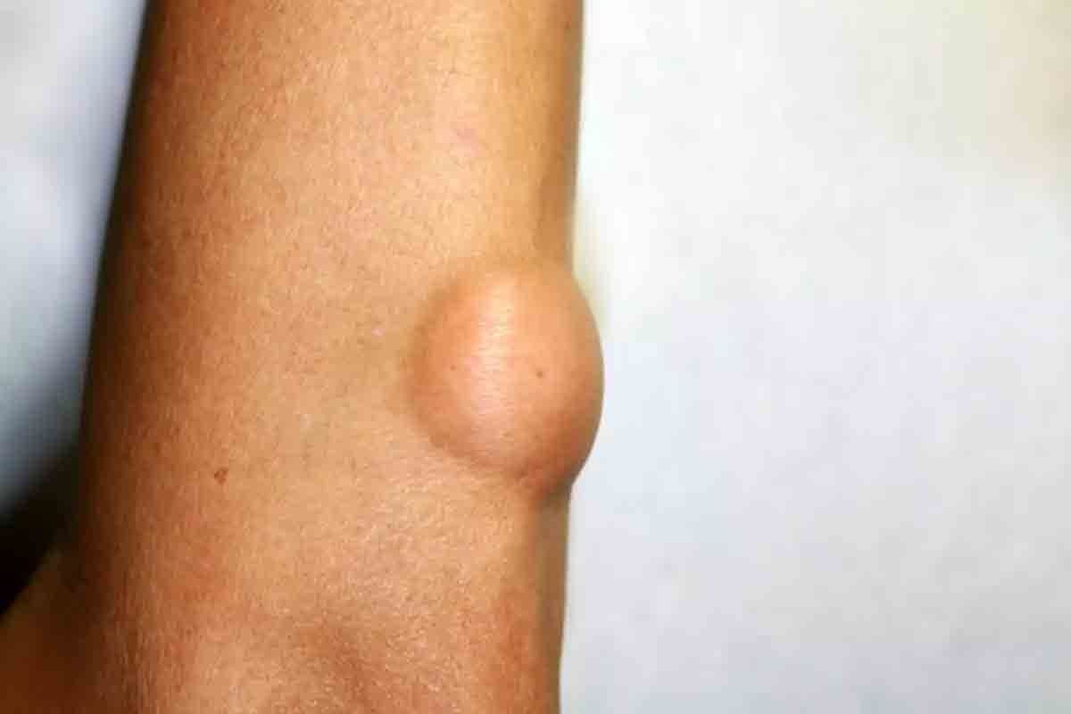 sarcoma in muscle — 8 Key Facts on Symptoms & Detection