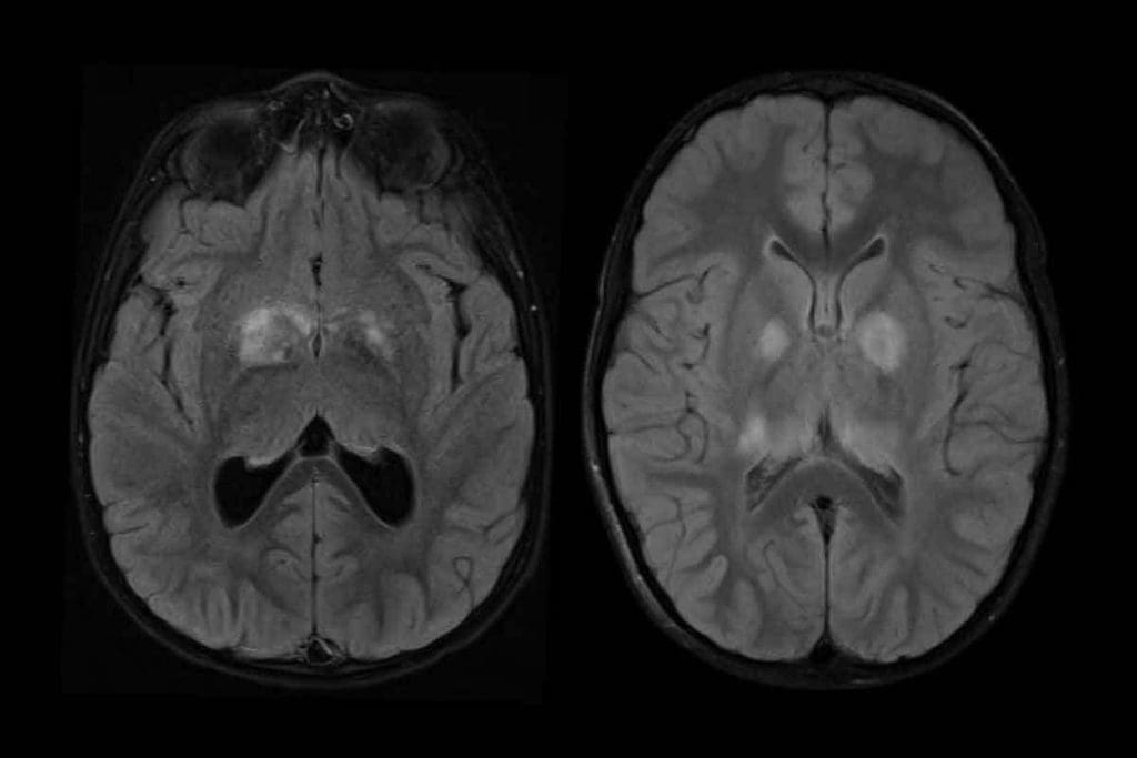 Brain Mass CT Scan: 7 Key Facts 1 Brain Mass CT Scan: 7 Key Facts
