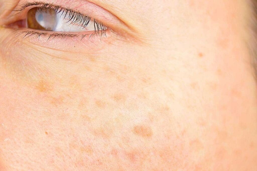 Skin Lymphoma Woman Signs of Leukemia in Adults: Top 10 Things to Know