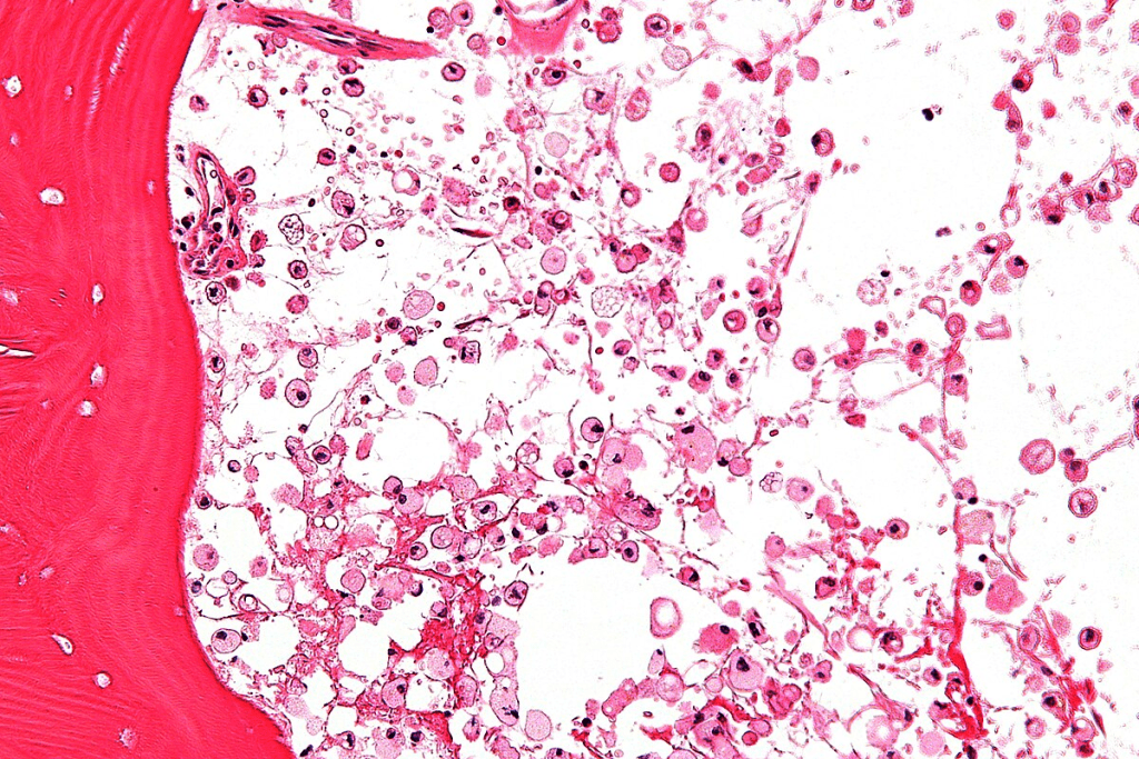 Microcytic Hypochromic Anemia: Master Negative