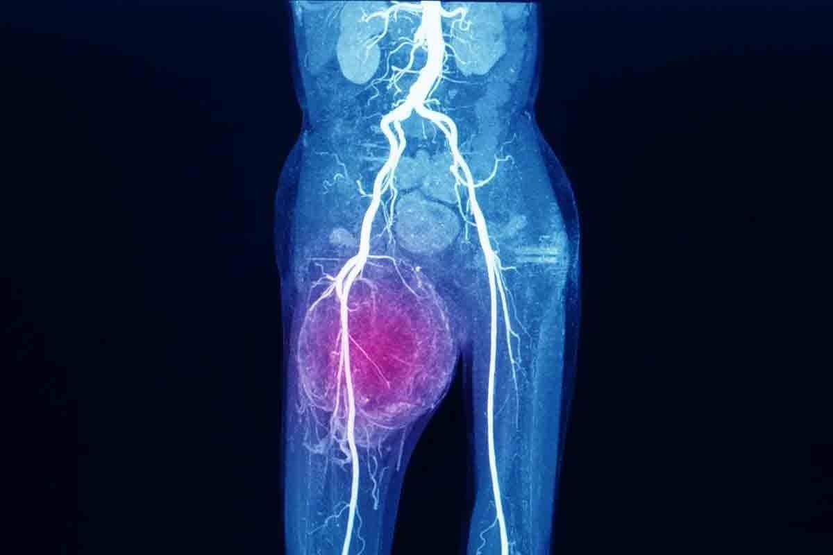 Ewing Sarcoma Cancer in Adults: Causes & Symptoms