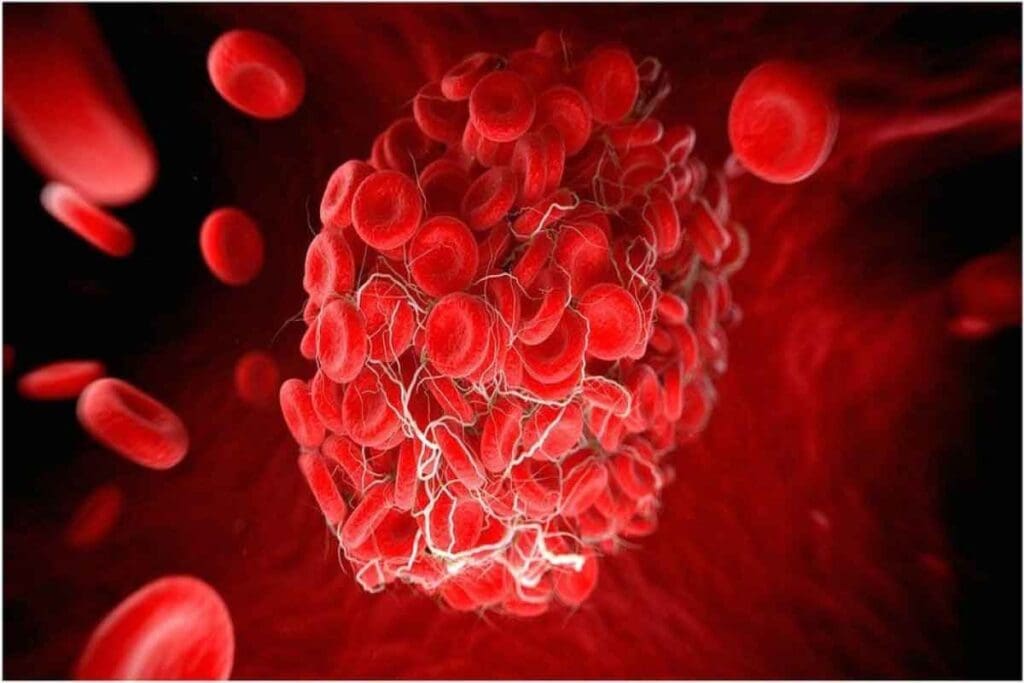 polycythemia diagnosis – 7 Key Criteria & Testing