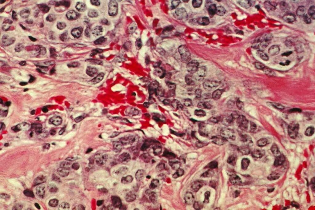 secondary polycythemia is cancer – Causes & Facts 3 secondary polycythemia is cancer – Causes & Facts