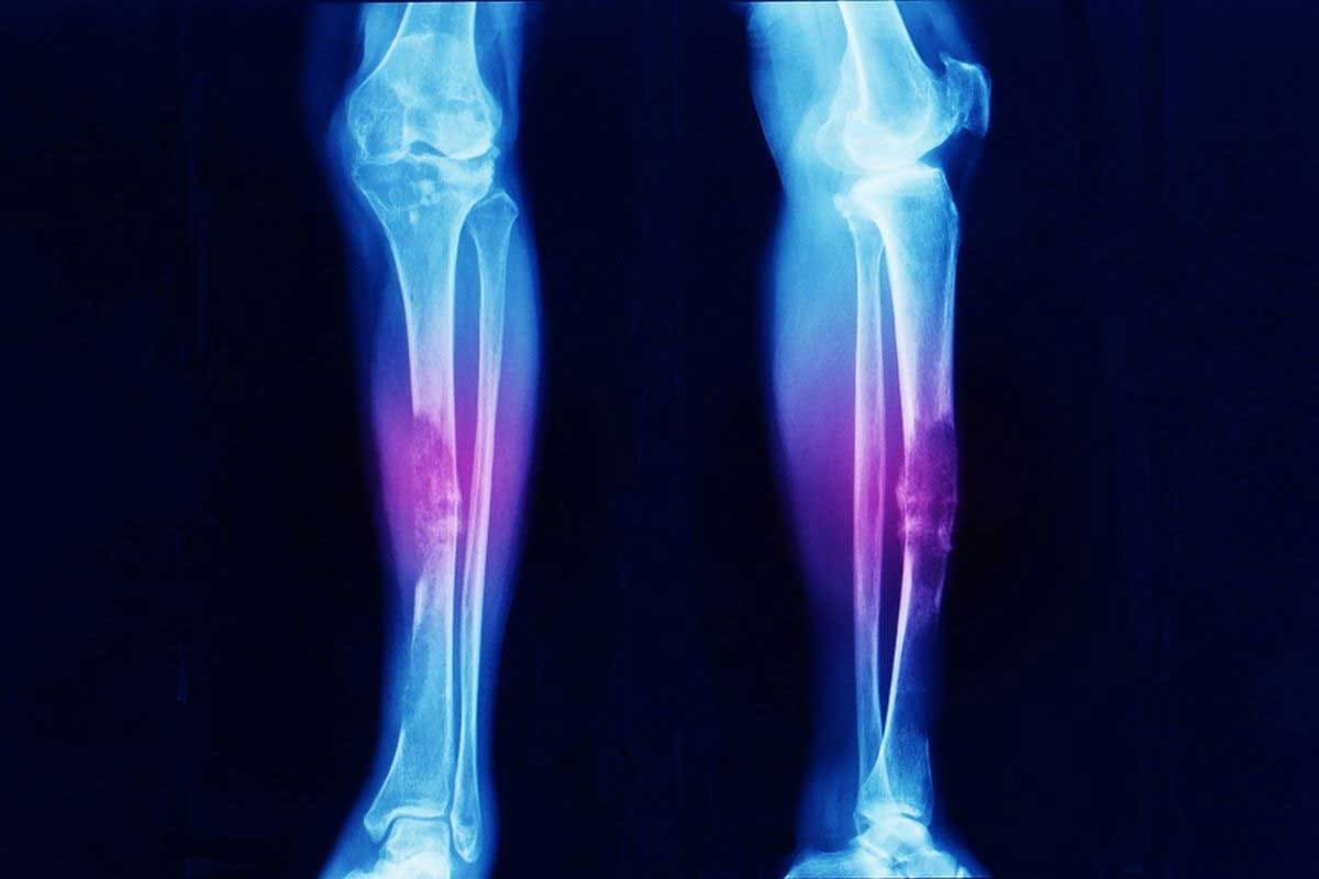 Is Ewing Sarcoma Curable? Key Facts