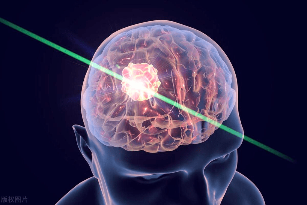 Brain Tumor Biopsy: 7 Key Facts 3 Brain Tumor Biopsy: 7 Key Facts